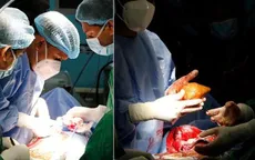 Phẫu thuật lấy viên sỏi thận lớn nhất thế giới từ một quân nhân về hưu
