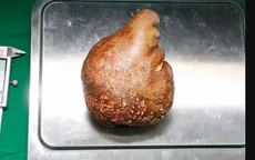 Thành công loại bỏ cục sỏi thận lớn nhất thế giới có kích thước bằng...quả bưởi