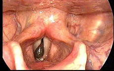 Gắp con đỉa to bằng ngón tay sống trong cổ họng nam bệnh nhân