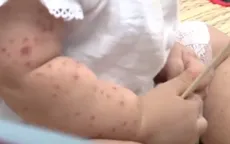 TP. Hồ Chí Minh: Xác định nguyên nhân gây bệnh tay chân miệng nặng ở trẻ em
