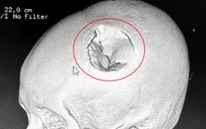 Xuyên đêm phẫu thuật cứu bệnh nhi bị vỡ lún xương sọ do ngã