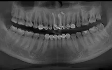 Nang xương hàm do bọc răng thẩm mỹ