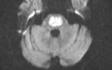Hội chứng tổn thương cầu não do hủy myelin thẩm thấu