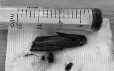 Lấy bỏ đoạn gỗ dài 6cm mắc kẹt sâu trong vùng mông bé trai