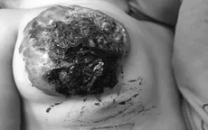 Cắt bỏ khối u mạch máu khổng lồ hiếm gặp ở ngực bé 23 tháng tuổi