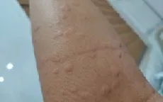 Sốc phản vệ độ 3 vì bị kiến đốt