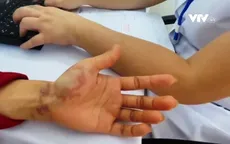 Cảnh báo nhiễm ấu trùng giun đũa từ chó mèo