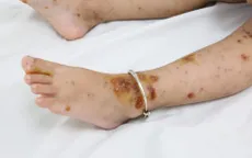 Chuyên gia khuyến cáo người dân nên tiêm vaccine, không chủ quan với bệnh thủy đậu