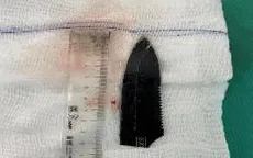 Phẫu thuật lấy lưỡi dao dài 10cm ra khỏi cơ thể nam thanh niên