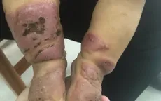 Người nhà tự ý sử dụng lá cây điều trị viêm da cơ địa, bệnh nhi 11 tháng tuổi bị hoại tử nặng nề