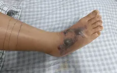 Truyền 70 lọ huyết thanh cấp cứu liên tiếp 3 bệnh nhân bị rắn cắn