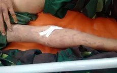 Nam bệnh nhân nguy kịch do nhiễm khuẩn huyết não mô cầu