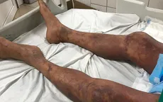 Suy đa tạng nguy kịch sau khi làm và ăn thịt lợn ốm