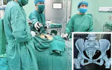 Dụng cụ tránh thai lạc chỗ xuyên thủng ruột