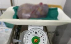 Cắt bỏ khối u buồng trứng nặng gần 3,5kg cho bệnh nhân cao tuổi