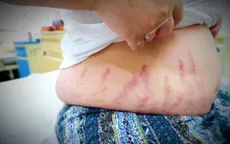 Lạm dụng thuốc xịt mũi, 2 anh em ruột bị suy tuyến thượng thận