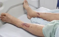 Cảnh báo nguy cơ tử vong do nhiễm liên cầu lợn