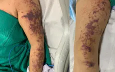 Người phụ nữ mắc liên cầu khuẩn sau khi ăn lòng lợn