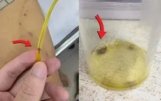 Hy hữu: Sán lá gan chui ra từ ống dẫn lưu đường mật