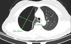 Thường xuyên đau tức ngực, khó thở vì khối kén khí phổi khổng lồ