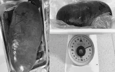 Cắt lách nặng 4kg cho bệnh nhân xơ hóa tủy cấp