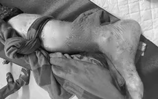 Cảnh báo: Bệnh nhân bị chó nhà nuôi cắn đứt rời bàn chân