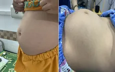 Cắt bỏ khối u buồng trứng nặng hơn 6kg cho bé gái 9 tuổi