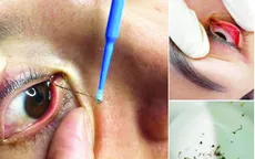 Bác sĩ nói gì về dịch vụ "bắt sâu mắt" đang nở rộ?