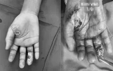 Cảnh báo tai nạn bỏng điện ở trẻ nhỏ
