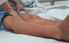 Cảnh báo nguy kịch do tự điều trị sốt xuất huyết tại nhà