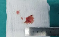 Gắp xương cá hình răng cưa mắc ở thực quản người đàn ông