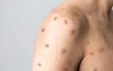 WHO giải đáp những câu hỏi đáng quan tâm về bệnh đậu mùa khỉ
