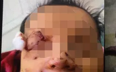 Bé sơ sinh nghi bị chuột cắn nhiều vết thương ở mặt