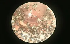 Ve chó làm tổ trong tai bé trai 7 tuổi