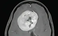 Mắc bệnh tâm thần liên quan đến u não