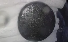 Uống nước vô tình nuốt luôn nắp chai rồi bỏ quên hơn 60 năm