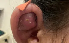 Cẩn trọng biến chứng nguy hiểm khi xỏ khuyên trên vành tai