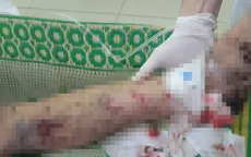 Nam thanh niên phải cắt bỏ cổ tay, nguy cơ mù mắt phải do pháo tự chế nổ