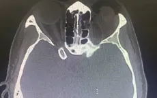 Cảnh báo: Xì mũi mạnh sau chấn thương gây tràn khí hốc mắt