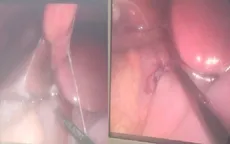 Cảnh báo thủng ổ loét dạ dày - tá tràng