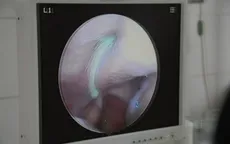 Viêm xoang do nấm - Những hậu quả khôn lường nếu không được điều trị đúng