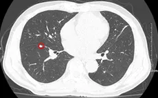 Sút 4kg trong 1 tuần, đi khám phát hiện mắc cùng lúc 2 loại ung thư