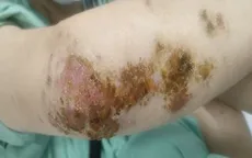 Thay đổi thói quen để kiểm soát bệnh viêm da cơ địa