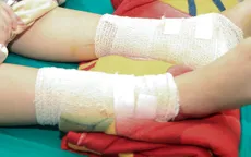 Bé gái bị bỏng nặng do nghịch cồn