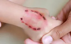 Bình Thuận ghi nhận trường hợp tử vong vì bệnh dại