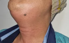 Dịp Tết và nguy cơ mắc bệnh viêm tấy lan tỏa vùng sàn miệng