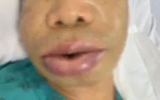 Bệnh hiếm gặp: Phù mạch di truyền