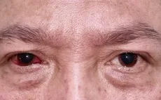 Xuất huyết kết mạc - không nên chủ quan