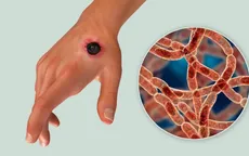 Thái Lan kêu gọi người dân cảnh giác với bệnh than