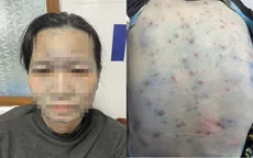 Nhiều bệnh nhân có bệnh lý nền nội tiết mắc bệnh thủy đậu có biến chứng nặng